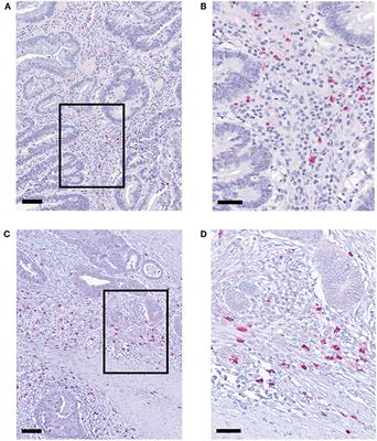 Neoadjuvant Radiochemotherapy Significantly Alters the Phenotype of Plasmacytoid Dendritic Cells and 6-Sulfo LacNAc+ Monocytes in Rectal Cancer